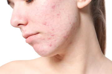 Young woman with acne problem on white background