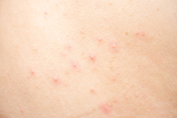 Allergic rash on the body.