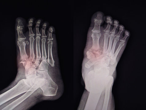X-ray Foot  Finidngs Fracture base of 1st-2nd metatarsal bone.
