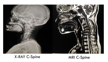Cevical spine image Normal X-ray and MRI : showing Severe narrowing disc space C4-5 with erosion...