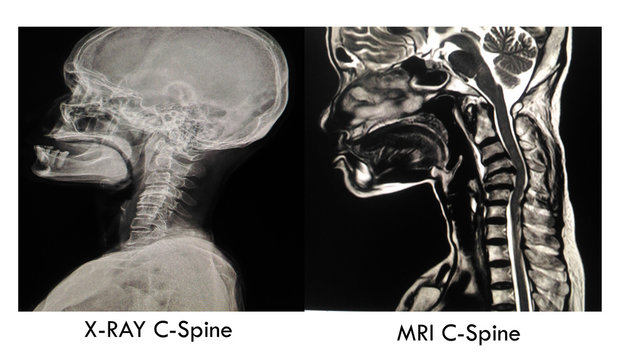 Cevical spine image Normal X-ray and MRI : showing Severe narrowing disc space C4-5 with erosion and sclerosis of end plates.