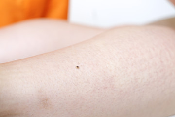 鍼治療 イメージ