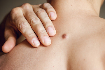 Fibroma on the male back, details, close-up - obrazy, fototapety, plakaty