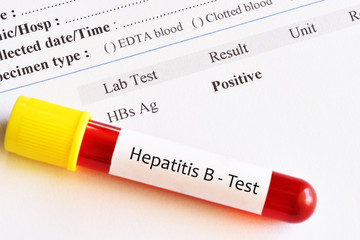Obraz premium Hepatitis B virus positive test result with blood sample tube