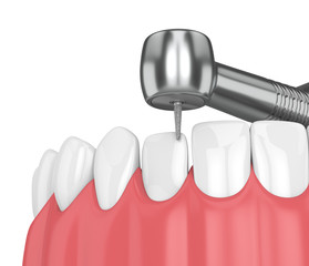 3d render of jaw with dental handpiece and drill