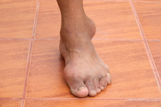 Close-up gout on a human foot