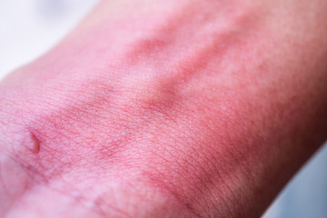 skin allergy with rash after mosquito bite
