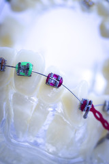 Dental metal brace teeth model