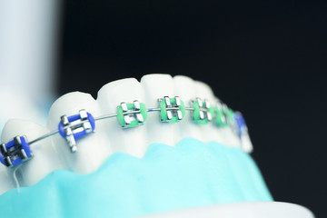 Dental metal brace teeth model