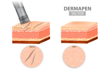 DERMAPEN. Microneedle stamping device. Skin before and after application Collagen induction therapy. Vector illustration