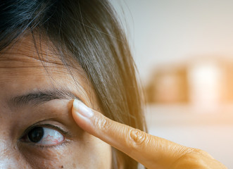 Veins on red eye asian woman,Eyelid layer,Causes the use of eyes and not enough rest