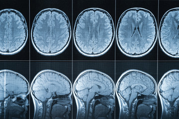 Magnetic resonance imaging of the head, MRI - obrazy, fototapety, plakaty