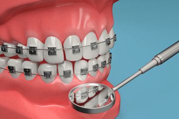 3D rendering from a dental brace check with a stomatoscope - 209362397