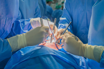 Doctors team wear blue coat perform heart surgery at the operating room in the hospital.