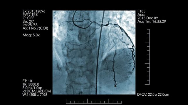 Angiography testing of heart vessels blue colored