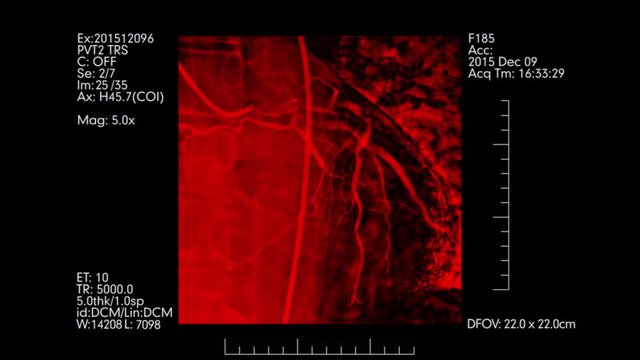 Red colored Heart vessels angiography testing display