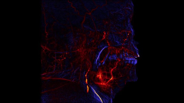 Blue and orange side view Brain vessels angiogram.