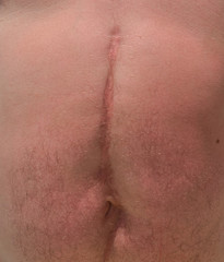 Fototapeta premium Scar on the abdomen after surgery in the navel area