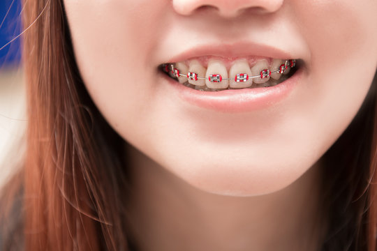 Asian woman smiling with dental braces.