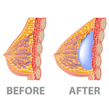 Breast implant before and after isolated on white vector