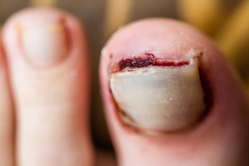 Newly Broken Nail About to Lift Away from the Finger