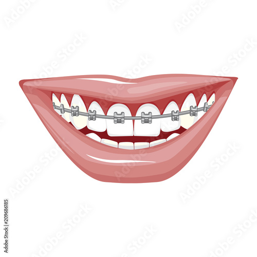 Free Free Smile With Braces Svg 121 SVG PNG EPS DXF File
