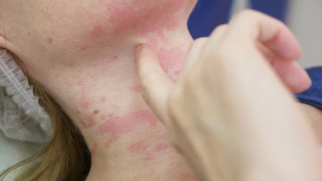 irritation on the skin of the patient after the procedure, allergic reaction. concept of beauty and cosmetology. 4k.