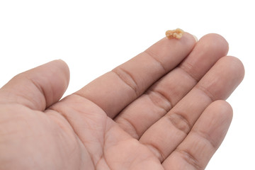 Tonsil Stone or Tonsillolith on the palm isolated on white background. Tonsil stones are hard deposits of debris that have lodged in tonsils.