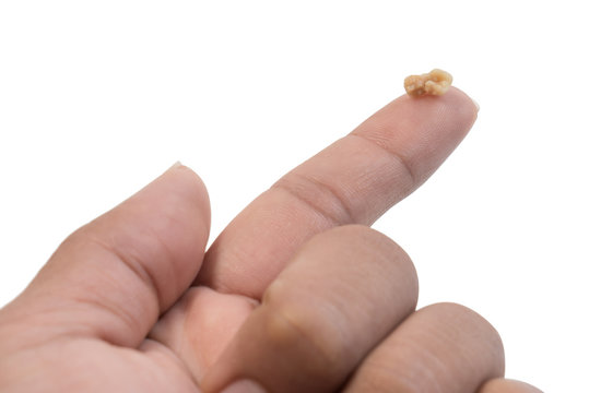 Tonsil Stone or Tonsillolith on the palm isolated on white background. Tonsil stones are hard deposits of debris that have lodged in tonsils.