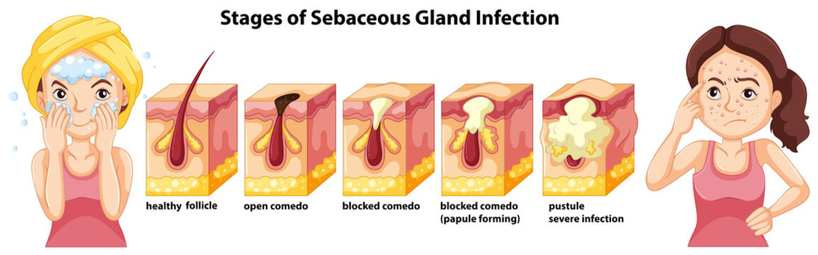 A Stages Of Sebaceous Gland Infection