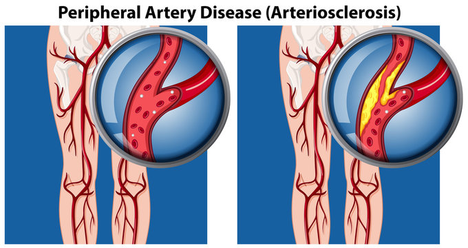 A Comparison of Peripheral Artery Disease