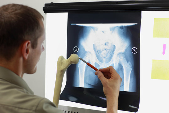 Professional with femur bone model watching image of hip - joint,  pelvis at x-ray film viewer. Diagnosis,treatment planning