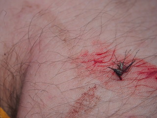 A dead mosquito in a pool of blood lies on the human skin.