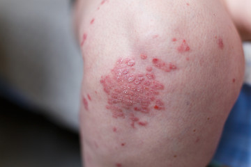 Allergic rash dermatitis eczema skin on leg of patient. Psoriasis and eczema skin with big red spots. Health concept