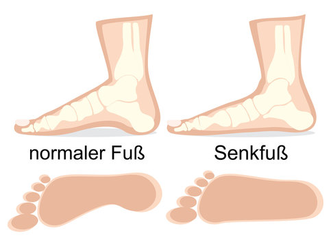 Darstellung normaler Fu&szlig; und Senkfu&szlig; im Vergleich 