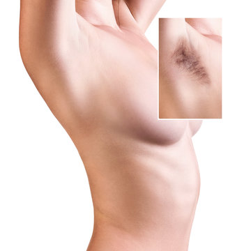 Woman showing her armpit before and after hair removal.