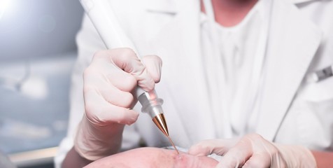 removal of papillomas, moles with a laser instrument in medical conditions. cosmetology services.