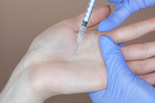 The doctor makes intramuscular injections of botulinum toxinon the palms of a woman against hyperhidrosis.