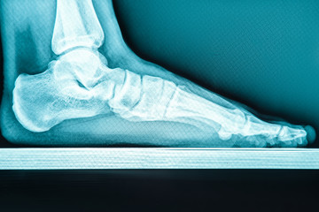 X-ray human foot with flatfoot