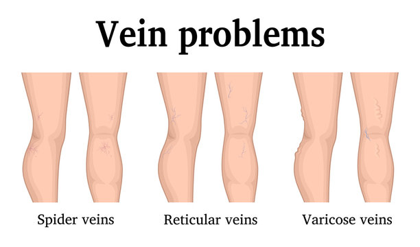 Illustration of vein problems