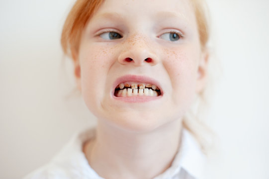 A girl with dental caries, dysplasia of enamel