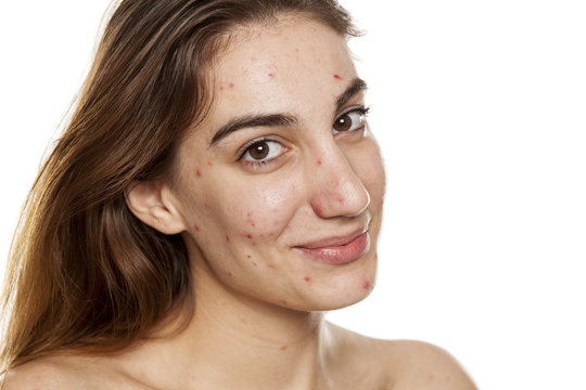 young smiling woman with problematic skin and without makeup poses on a white background