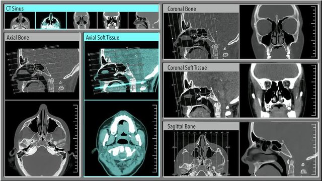 CT sinus scan (Computed tomography) (CAT scan). Healthy sinuses of adolescent female. 5 different scan modes. Interface is my own original design. Individual elements included at end.
