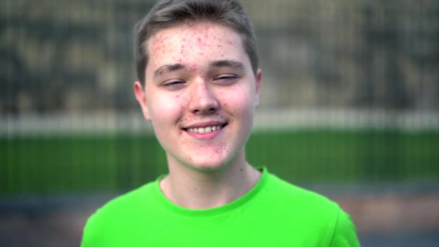 Teenage boy with puberty acne problem. Teenage skin