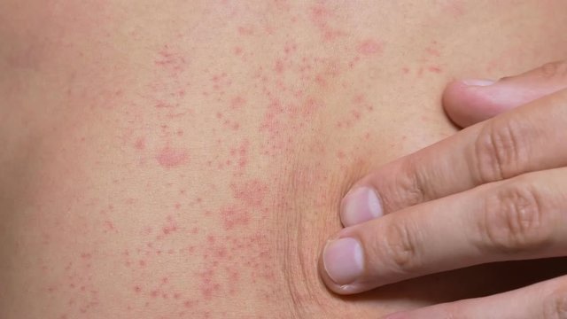 4k, a man with a naked torso scratches a red rash on his stomach.