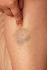 A bruise on the skin of a man