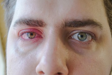 Two red eyes of man is watching to the camera. One right eye eyelid abscess