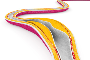 Cholesterol plaque in artery