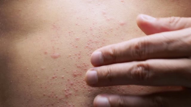 4k, a man with a naked torso scratches a red rash on his stomach. Slow motion