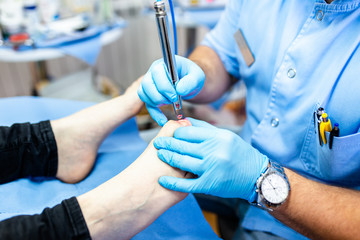 Toenail fungus treatment with foot laser at laser nail therapy clinic. © hedgehog94